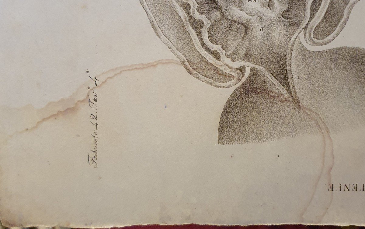 Gravure Anatomique Pathologique Maladie Du Petit Intestin Par Jean Cruveilhier 1839 -photo-3