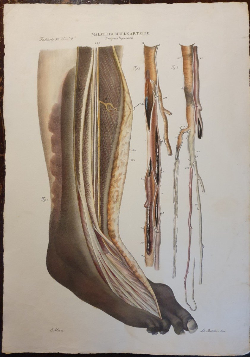 Color Engraving Anatomical Pathology Gangrene Disease By Jean Cruveilhier 1839 