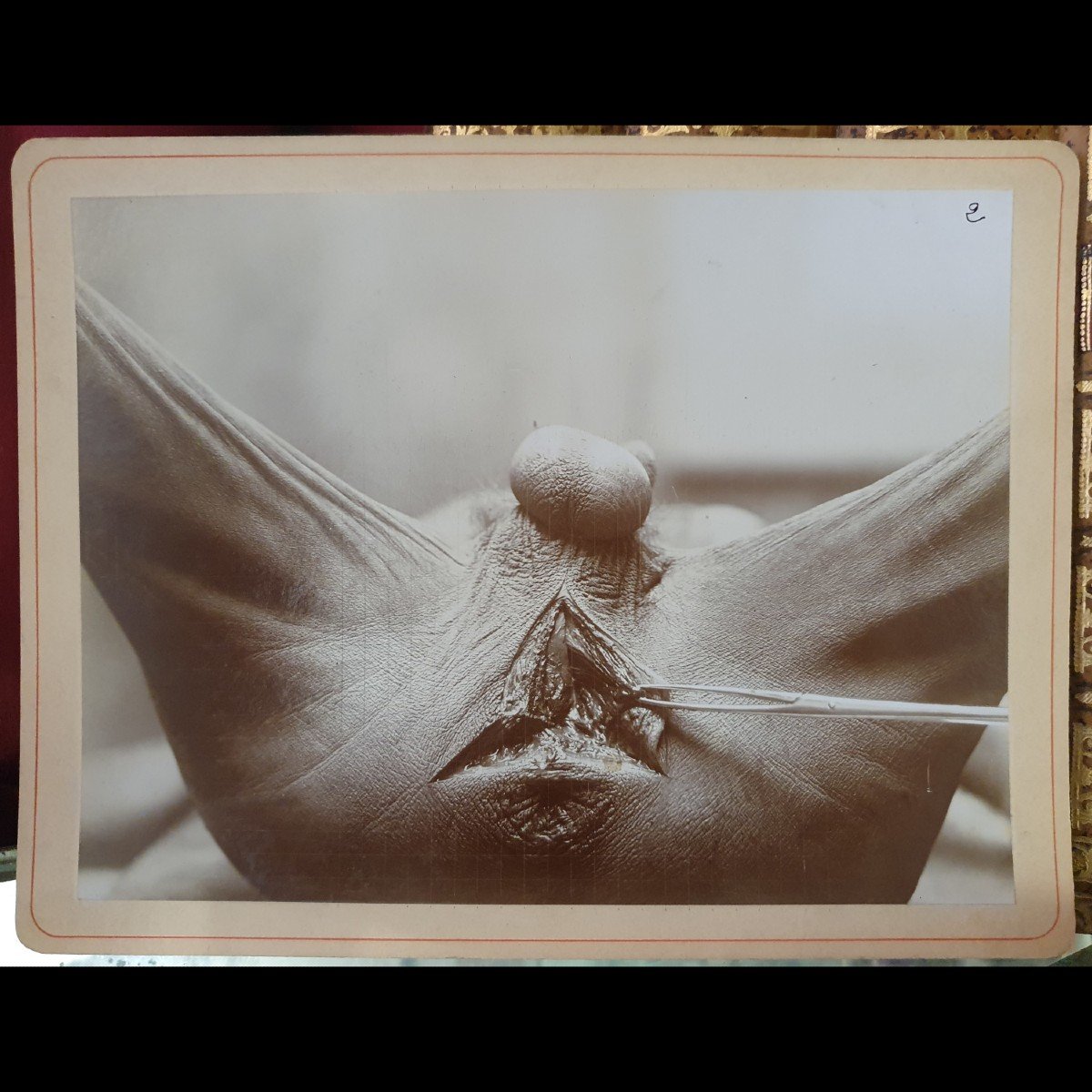 Curiosity: Three Medical Photographs Of An Operation, Early 20th Century-photo-2