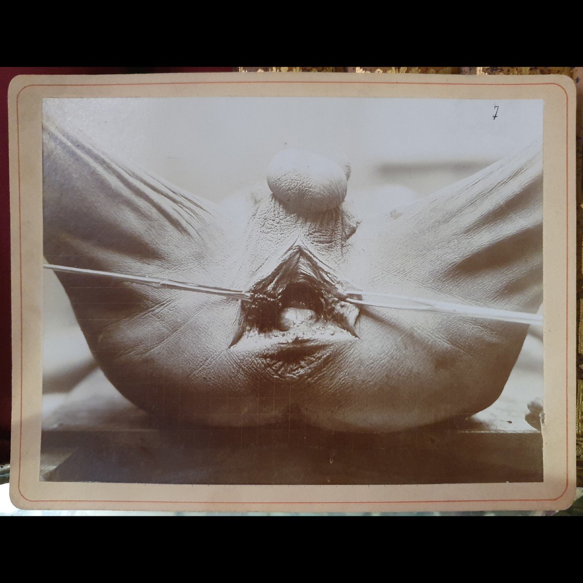 Curiosity: Three Medical Photographs Of An Operation, Early 20th Century-photo-4