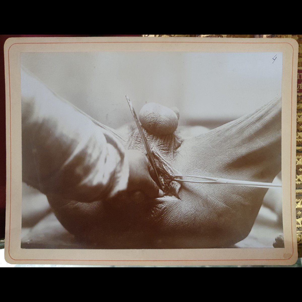 Curiosity: Three Medical Photographs Of An Operation, Early 20th Century-photo-2