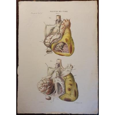 Gravure Couleur Anatomique Pathologique Maladie Du Coeur Jean Cruveilhier 1839