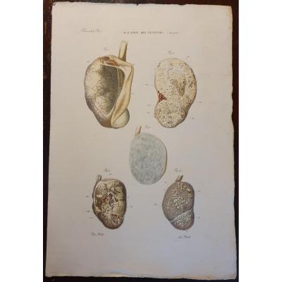 Engraving Colour Anatomical Pathological Testis Disease Jean Cruveilhier 1839