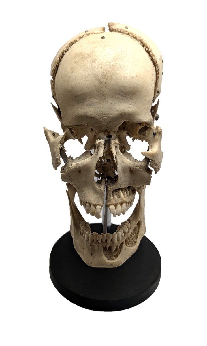 Exploded Human Skull, Beauchêne