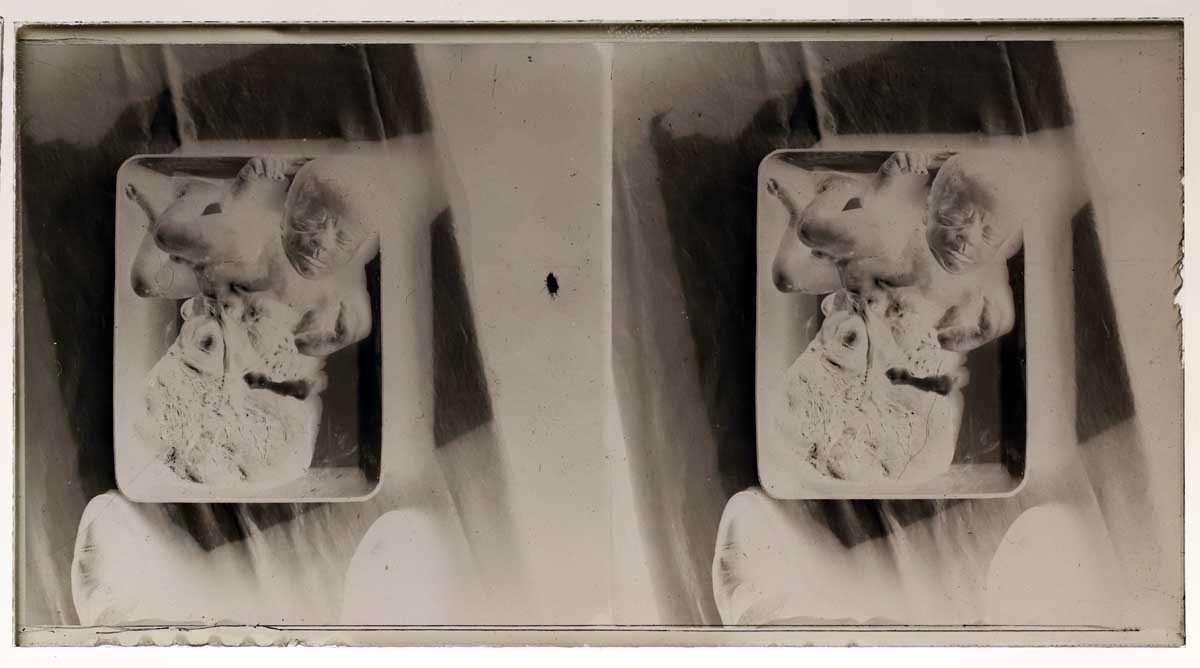 Photographs 13 Medical Stereos Gynecology Circa 1900 - 1920-photo-1