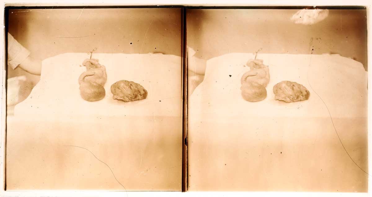 Photographs 13 Medical Stereos Gynecology Circa 1900 - 1920-photo-3