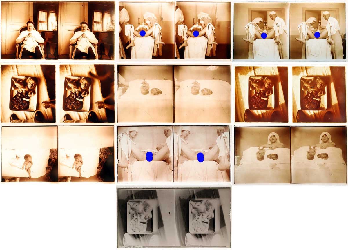 Photographs 13 Medical Stereos Gynecology Circa 1900 - 1920