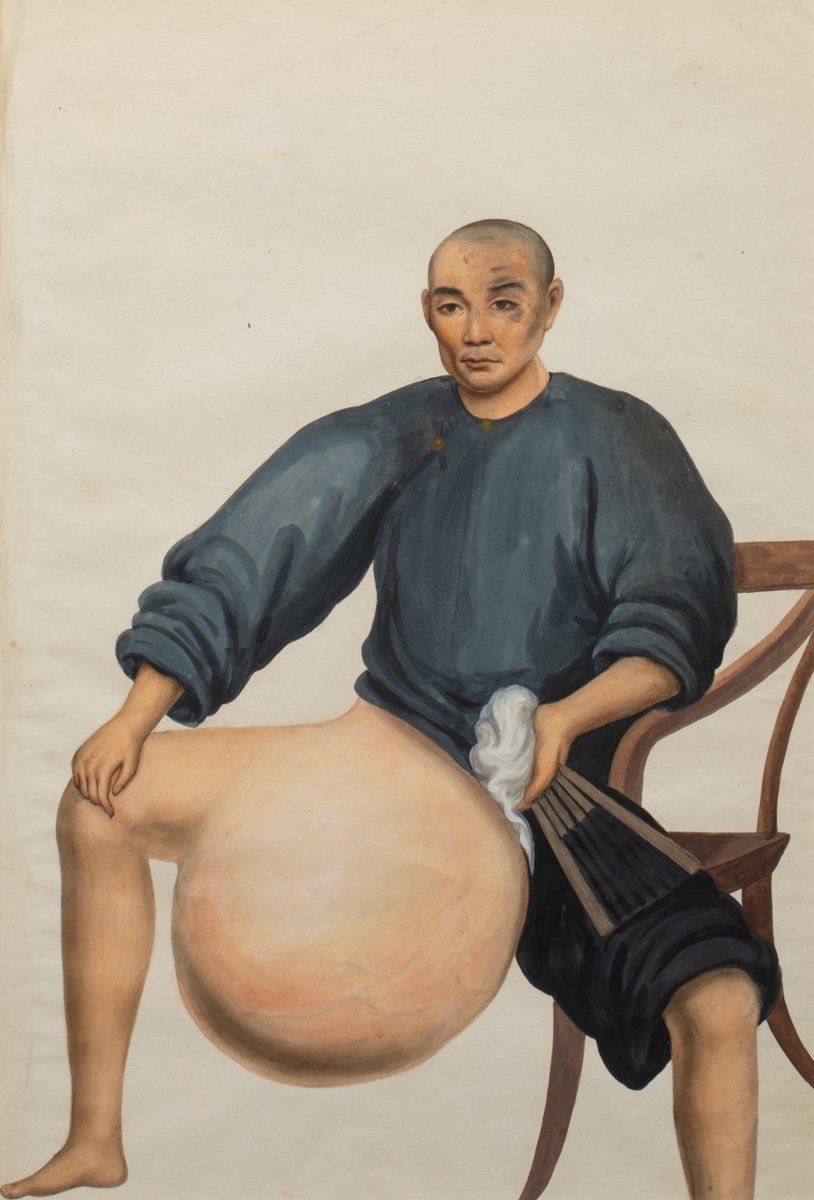 Medical Portrait Of A Chinese Cancer Patient, 19th Century Cercle De Lam Qua (1801-1860)-photo-2