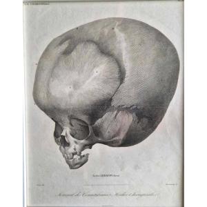 Hydrocephalus Anatomical Plate - Engraving - Medical-surgical Knowledge Journal - Medicine